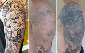 Удаление татуировок от мастера Цилик Дмитрий. Фото #32786