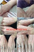 Мезотерапия лица от мастера Днепрова Ксения. Фото #25962